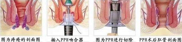 PPH手术图.jpg