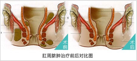 治疗肛周脓肿前后对比图.jpg